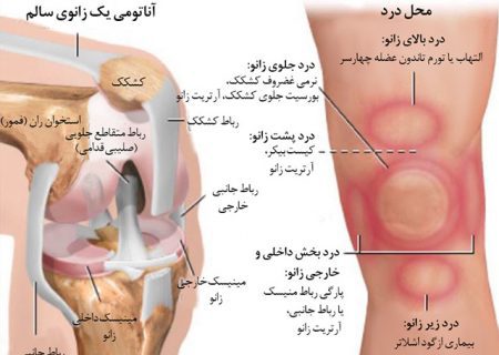 علتهای مختلف درد زانو