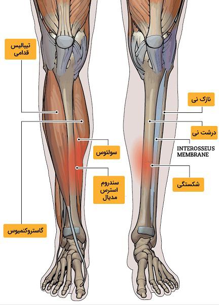 علت درد جلوی ساق یا شین اسپلینت چیست