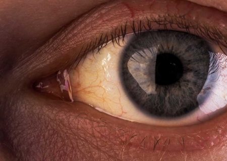 زرد شدن چشم نشانه ای از بیماری سندرم ژیلبرت در کوهنوردان