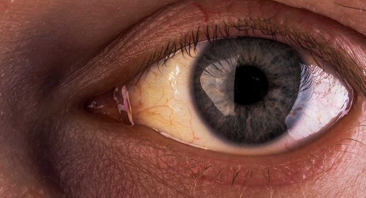 زرد شدن چشم نشانه ای از بیماری سندرم ژیلبرت در کوهنوردان