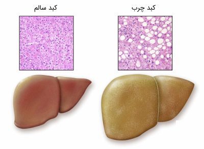 كبد چرب به زبان ساده